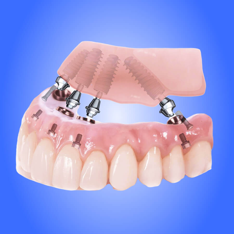 Восстановление при полной потере зубов на имплантах