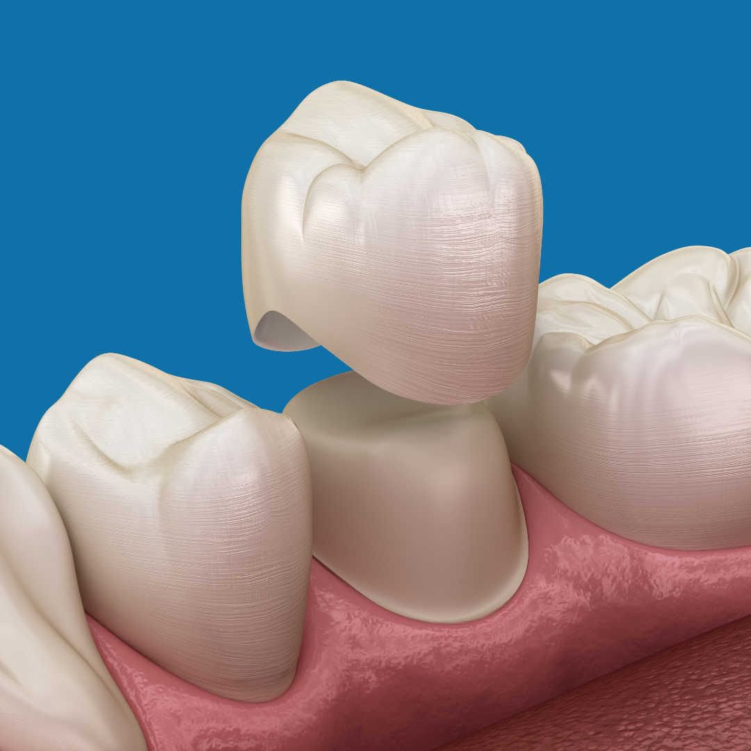 Зубное протезирование