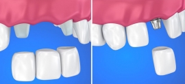Выбираем способ протезирования зубов. Что лучше – классический мост или имплантат?